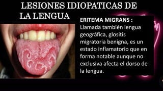 LESIONES IDIOPATICAS DE
LA LENGUA ERITEMA MIGRANS :
Llamada también lengua
geográfica, glositis
migratoria benigna, es un
estado inflamatorio que en
forma notable aunque no
exclusiva afecta el dorso de
la lengua.
 
