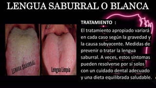 TRATAMIENTO :
El tratamiento apropiado variará
en cada caso según la gravedad y
la causa subyacente. Medidas de
prevenir o tratar la lengua
saburral. A veces, estos síntomas
pueden resolverse por sí solos
con un cuidado dental adecuado
y una dieta equilibrada saludable.
LENGUA SABURRAL O BLANCA
 