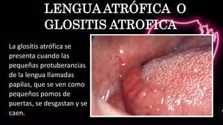 La glositis atrófica se
presenta cuando las
pequeñas protuberancias
de la lengua llamadas
papilas, que se ven como
pequeños pomos de
puertas, se desgastan y se
caen.
LENGUA ATRÓFICA O
GLOSITIS ATROFICA
 