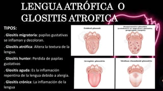 TIPOS:
. Glositis migratoria: papilas gustativas
se inflaman y decoloran.
. Glositis atrófica: Altera la textura de la
lengua.
. Glositis hunter: Perdida de papilas
gustativas
. Glositis aguda: Es la inflamación
repentina de la lengua debido a alergia.
. Glositis crónica: La inflamación de la
lengua
LENGUA ATRÓFICA O
GLOSITIS ATROFICA
 