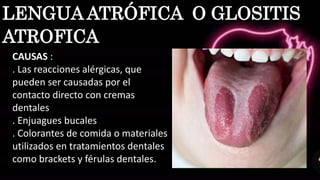 CAUSAS :
. Las reacciones alérgicas, que
pueden ser causadas por el
contacto directo con cremas
dentales
. Enjuagues bucales
. Colorantes de comida o materiales
utilizados en tratamientos dentales
como brackets y férulas dentales.
LENGUA ATRÓFICA O GLOSITIS
ATROFICA
 