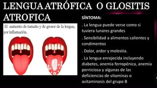 SÍNTOMA:
. La lengua puede verse como si
tuviera lunares grandes
. Sensibilidad a alimentos calientes y
condimentos
. Dolor, ardor y molestia.
. La lengua enrojecida incluyendo
diabetes, anemia ferropénica, anemia
perniciosa y algunas de las
deficiencias de vitaminas o
avitaminosis del grupo B
LENGUA ATRÓFICA O GLOSITIS
ATROFICA
 