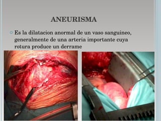 ANEURISMA Es la dilatacion anormal de un vaso sanguineo, generalmente de una arteria importante cuya rotura produce un derrame  