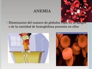 ANEMIA Disminucion del numero de globulos rojos en la sangre o de la cantidad de hemoglobina presente en ellos  