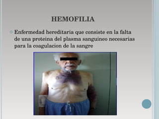 HEMOFILIA Enfermedad hereditaria que consiste en la falta de una proteina del plasma sanguineo necesarias para la coagulacion de la sangre  