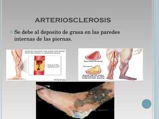 ARTERIOSCLEROSIS Se debe al deposito de grasa en las paredes internas de las piernas.  