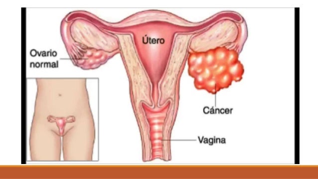 Enfermedades del aparato reproductor femenino