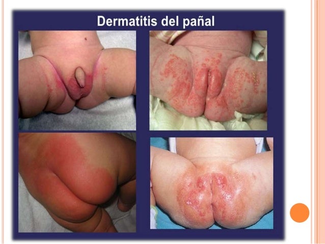 Como curar el hongo de las uñas medikamentozno