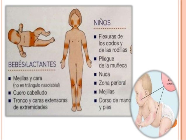 El cuarto de baño con la celidonia mayor de la psoriasis