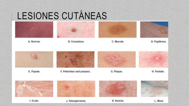 La psoriasis vulgar sobre la cabeza