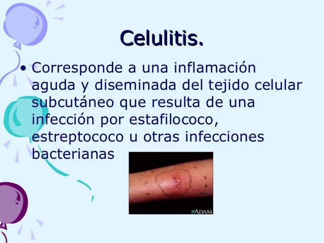 Que crema del hongo de las uñas en los pies