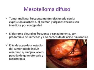 Mesotelioma difuso
• Tumor maligno, frecuentemente relacionado con la
  exposicion al asbesto, el pulmon y organos vecinos son
  invadidos por contiguidad

• El derrame pleural es frecuente y sanguinolento, con
  predominio de linfocitos y alto contenido de acido hialuronico

 El tx de acuerdo al estadio
  del tumor puede incluir
  reseccion quirurgica, acom-
  panada de quimioterapia y
  radioterapia
 