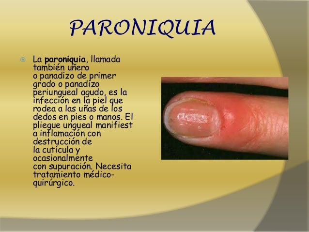 Al tratamiento del hongo de las uñas después de la desaparición de la uña
