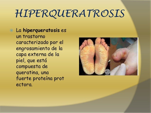 El tratamiento de las uñas encarnadas en los pies las mejores metodologías 2016