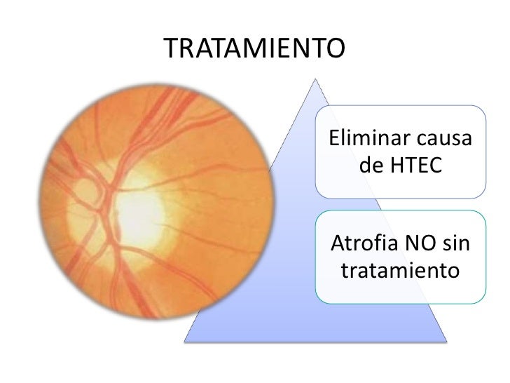 Enfermedades del nervio optico