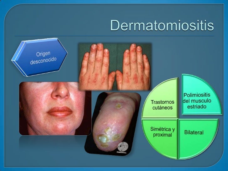 Enfermedades del tejido conectivo (dermatologia) Enfermedades del tejido conectivo (dermatologia)