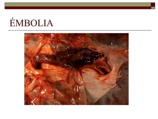 ÉMBOLIA 