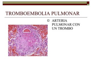 TROMBOEMBOLIA PULMONAR ARTERIA PULMONAR CON UN TROMBO 