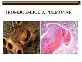 TROMBOEMBOLIA PULMONAR 