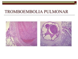 TROMBOEMBOLIA PULMONAR 