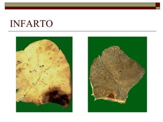 INFARTO 