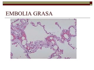 EMBOLIA GRASA 