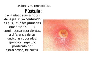 Lesiones macroscópicas
Pústula:
cavidades circunscriptas
de la piel cuyo contenido
es pus, lesiones primarias
que desde s u
comienzo son purulentas,
a diferencia de las
vesículas supuradas.
Ejemplos: impétigo
producido por
estafilococo, foliculitis.
 