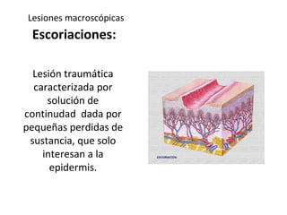 Lesiones macroscópicas
Escoriaciones:
Lesión traumática
caracterizada por
solución de
continudad dada por
pequeñas perdidas de
sustancia, que solo
interesan a la
epidermis.
 