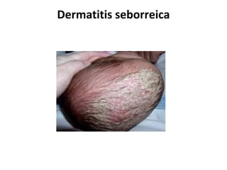 Dermatitis seborreica
 