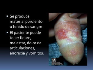 Se produce material purulento o teñido de sangreEl paciente puede tener fiebre, malestar, dolor de articulaciones, anorexia y vómitos.
