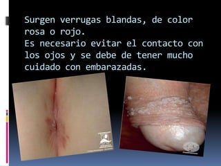 Surgen verrugas blandas, de color rosa o rojo.Es necesario evitar el contacto con los ojos y se debe de tener mucho cuidado con embarazadas.