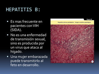 HEPATITIS B:Es mas frecuente en pacientes con VIH (SIDA).No es una enfermedad de transmisión sexual, sino es producida por un virus que ataca al hígado. Una mujer embarazada puede transmitirlo al feto en desarrollo.