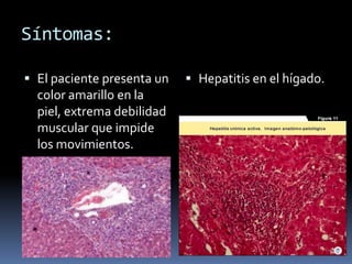 Síntomas:El paciente presenta un color amarillo en la piel, extrema debilidad muscular que impide los movimientos.  Hepatitis en el hígado.