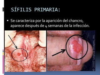 SÍFILIS PRIMARIA:Se caracteriza por la aparición del chancro, aparece después de 4 semanas de la infección.