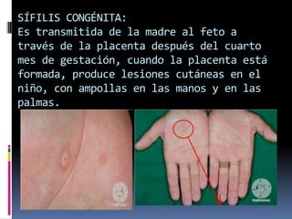 SÍFILIS CONGÉNITA: Es transmitida de la madre al feto a través de la placenta después del cuarto mes de gestación, cuando la placenta está formada, produce lesiones cutáneas en el niño, con ampollas en las manos y en las palmas.