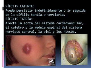 SÍFILIS LATENTE:Puede persistir indefinidamente o ir seguida de la sífilis tardía o terciaria.SÍFILIS TARDÍA:Afecta la aorta del sistema cardiovascular, el celebro y la medula espinal del sistema nervioso central, la piel y los huesos. 