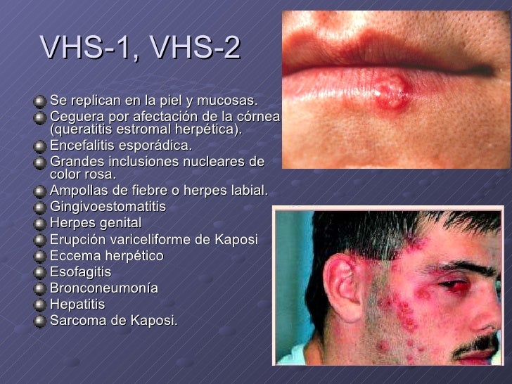 Enfermedades de transmisión sexual Enfermedades de transmisión sexual