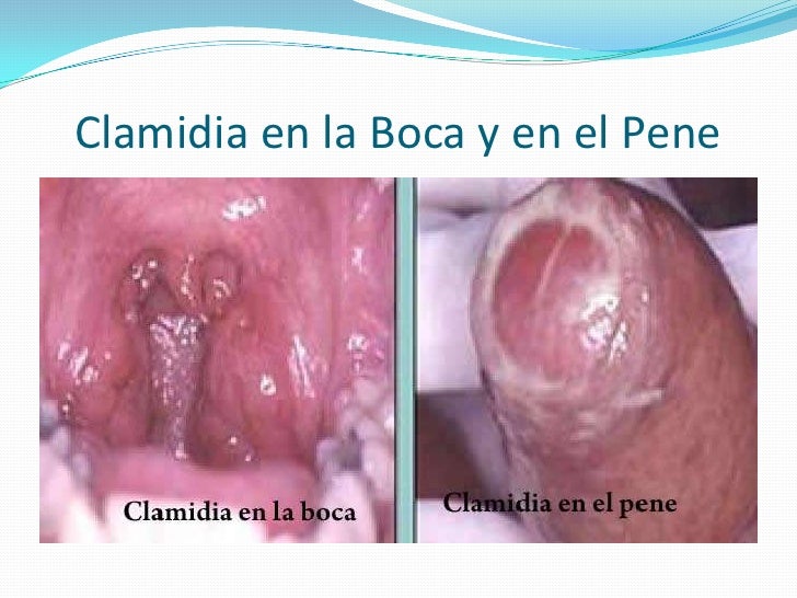 Resultado de imagen para CLAMIDIA HOMBRES Y MUJERES