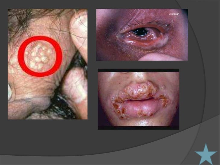 Enfermedades De Transmision Sexual