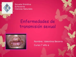 Enfermedades de
transmisión sexual
Nombre: Valentina Becerra
Curso:7 año a
Escuela Primitiva
Echeverría
Ciencias Naturales
 