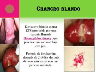 Enfermedades de transmision sexual | PPTX