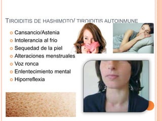 TIROIDITIS DE HASHIMOTO/ TIROIDITIS AUTOINMUNE
 Cansancio/Astenia
 Intolerancia al frio
 Sequedad de la piel
 Alteraciones menstruales
 Voz ronca
 Enlentecimiento mental
 Hiporreflexia
 