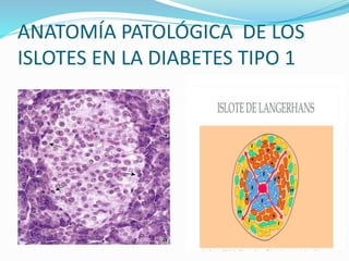 ANATOMÍA PATOLÓGICA DE LOS
ISLOTES EN LA DIABETES TIPO 1
 