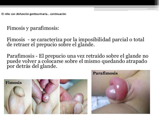 Que hacer si el miembro menos puesto