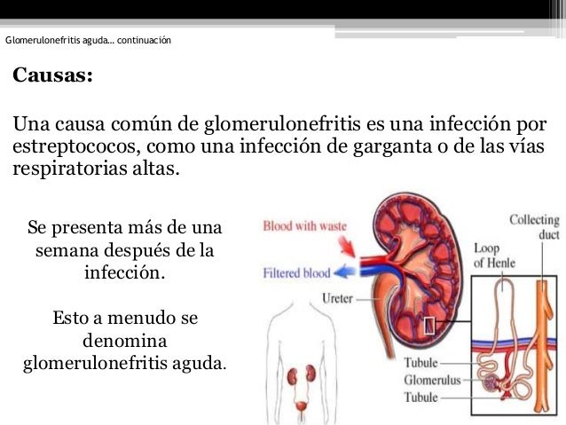 Si puede bajar la temperatura a la osteocondrosis