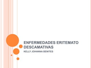 ENFERMEDADES ERITEMATO
DESCAMATIVAS
KELLY JOHANNA BENITES
 
