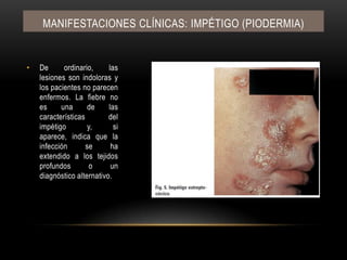 Manifestaciones clínicas: IMPÉTIGO (PIODERMIA)De ordinario, las lesiones son indoloras y los pacientes no parecen enfermos. La fiebre no es una de las características del impétigo y, si aparece, indica que la infección se ha extendido a los tejidos profundos o un diagnóstico alternativo.