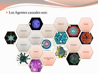  Los Agentes causales son:
Adenovirus
Citomegalovirus
Enterovirus Epstein barr
Herpes 6-7
Sarampión
Varicela Parvovirus
Rubeola
Virus del oeste del
nilo
 