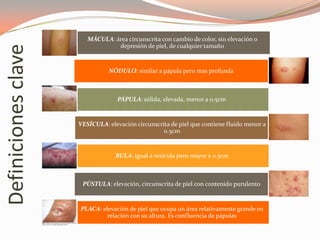 Definicionesclave
MÁCULA: área circunscrita con cambio de color, sin elevación o
depresión de piel, de cualquier tamaño
NÓDULO: similar a pápula pero mas profunda
PÁPULA: sólida, elevada, menor a 0.5cm
VESÍCULA: elevación circunscrita de piel que contiene fluido menor a
0.5cm
BULA: igual a vesícula pero mayor a 0.5cm
PÚSTULA: elevación, circunscrita de piel con contenido purulento
PLACA: elevación de piel que ocupa un área relativamente grande en
relación con su altura. Es confluencia de pápulas
 