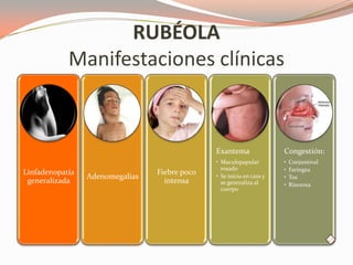 RUBÉOLA
Manifestaciones clínicas
Linfadenopatía
generalizada
Adenomegalias
Fiebre poco
intensa
Exantema
• Maculopapular
rosado
• Se inicia en cara y
se generaliza al
cuerpo
Congestión:
• Conjuntival
• Faringea
• Tos
• Rinorrea
 